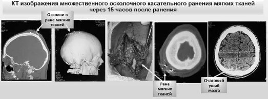 КТ изображение множественного осколочного касательного ранения мягких тканей свода черепа, сопровождающееся очаговым ушибом мозга